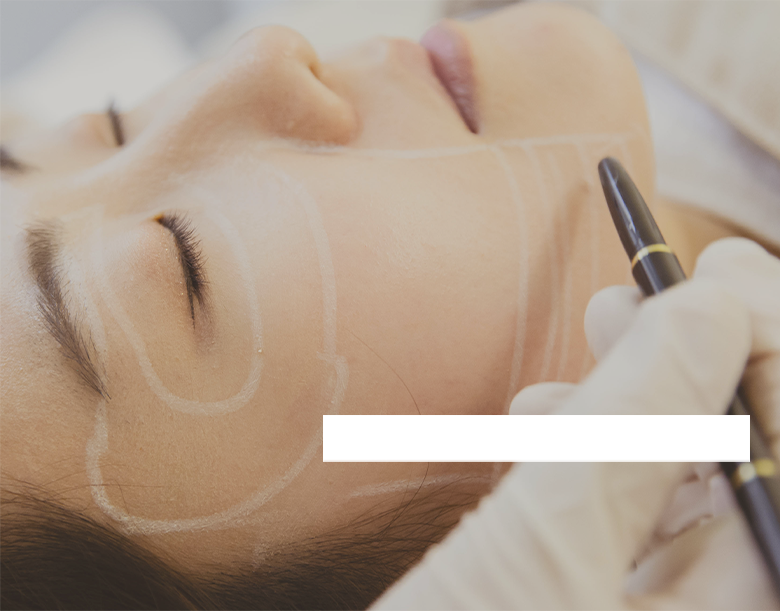 Silhouette Soft Cone-shaped thread volume lifting