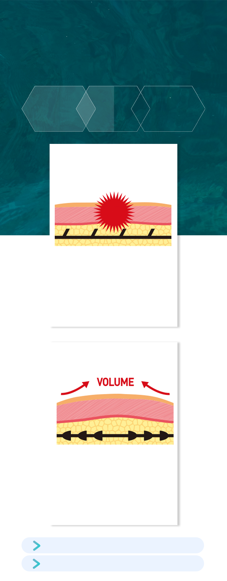 Conventional lifting threads vs. Silhouette Soft comparison