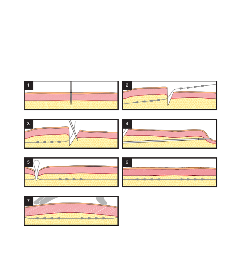 Silhouette Soft treatment method