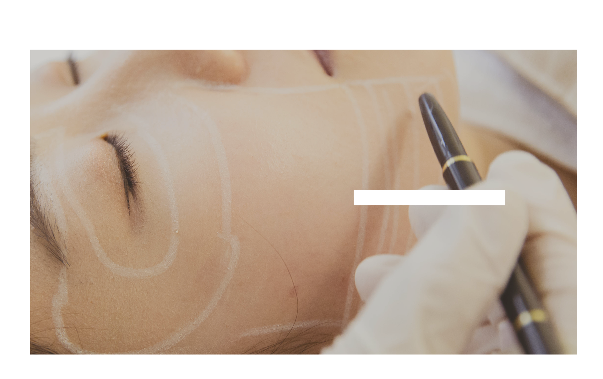 Silhouette Soft Cone-shaped thread volume lifting