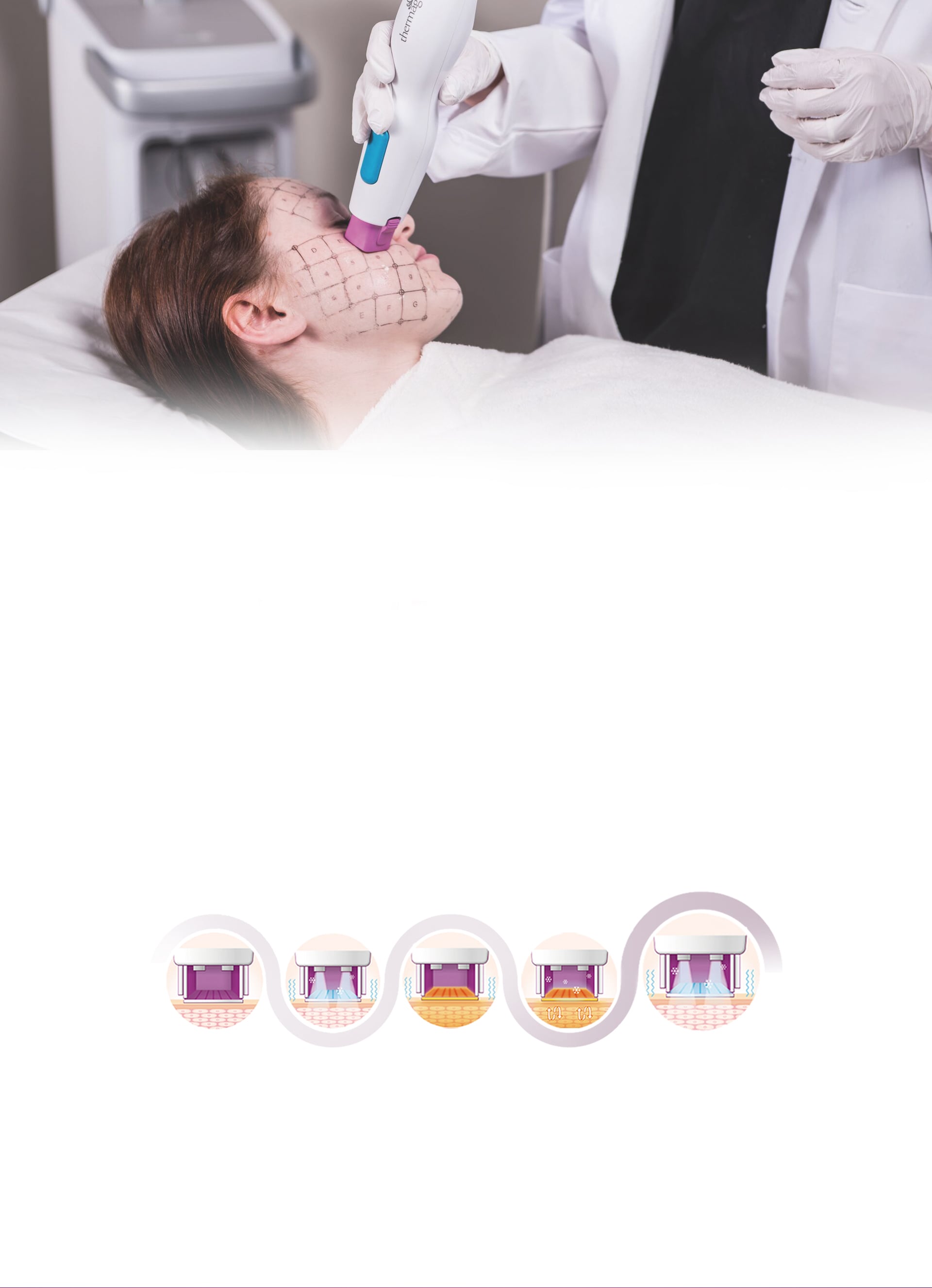 Thermage FLX Principle and Procedure