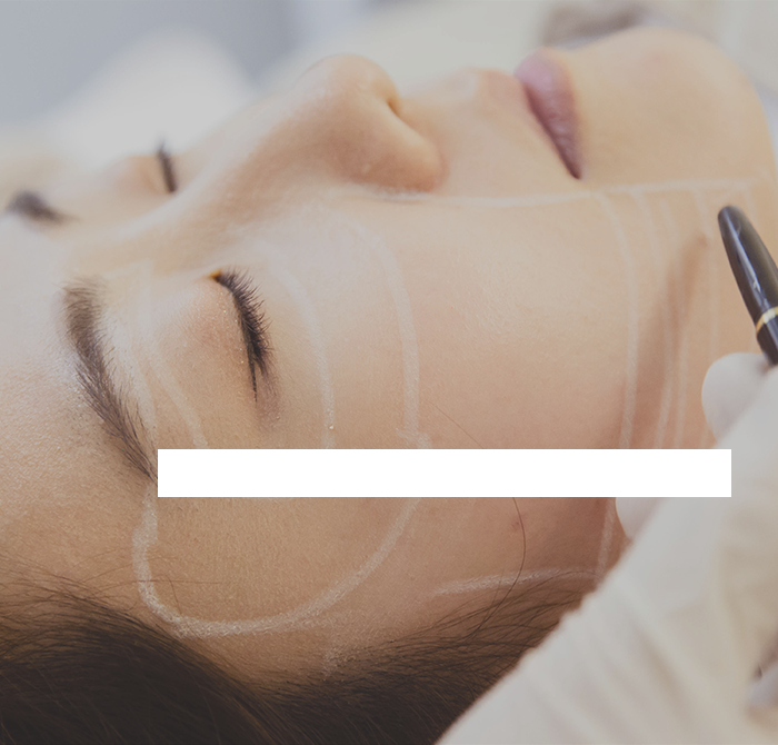 Thread Lifting - threads matched to skin condition are injected into the dermis for a naturally refined facial line