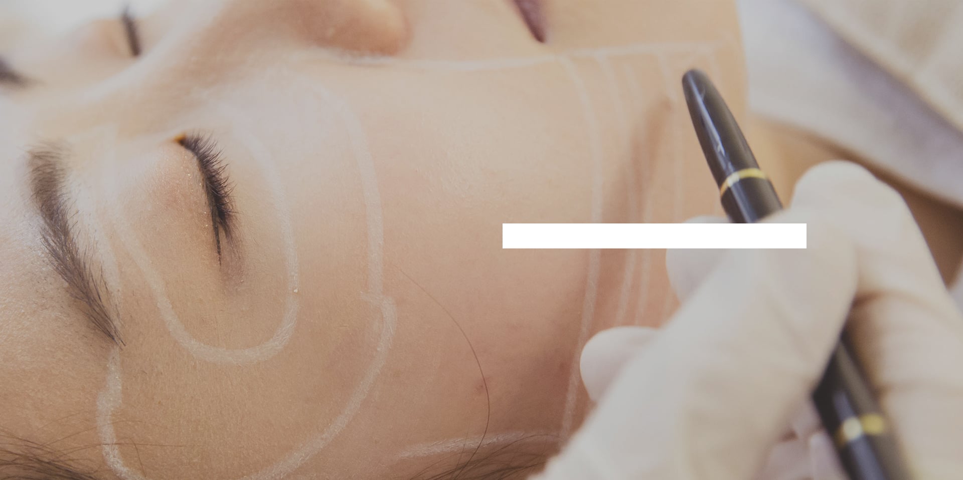 Thread Lifting - threads matched to skin condition are injected into the dermis for a naturally refined facial line