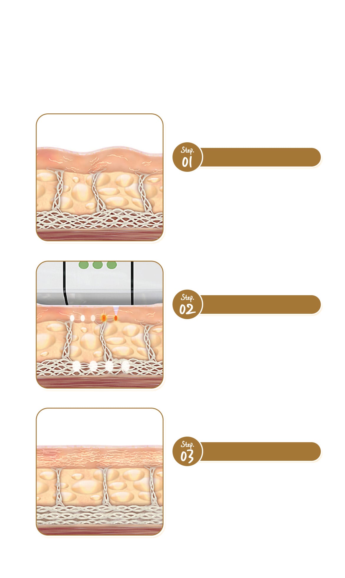 Principle of Ultherapy Lifting - from sagging skin due to collagen loss to firm, elastic skin after Ultherapy treatment
