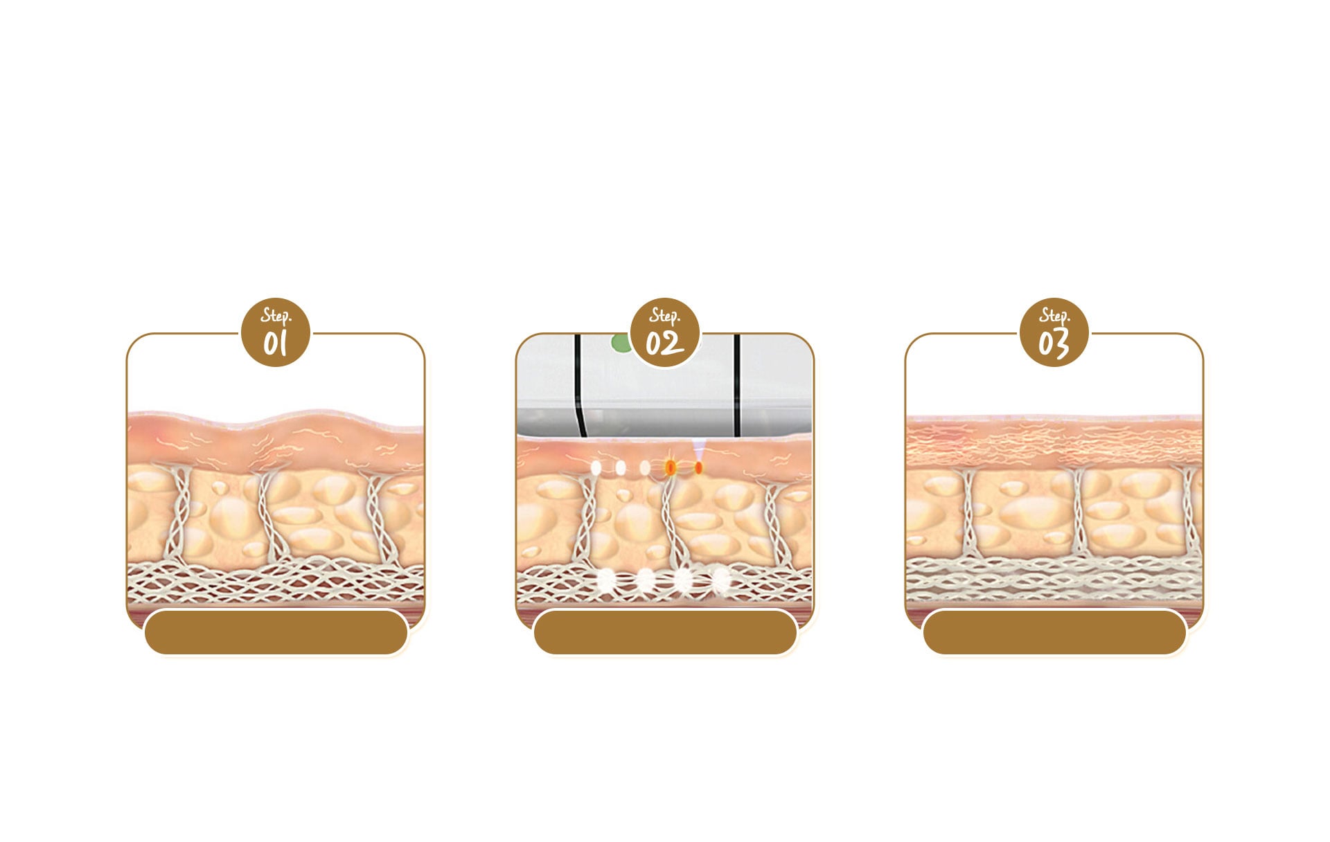 Principle of Ultherapy Lifting - from sagging skin due to collagen loss to firm skin after Ultherapy treatment