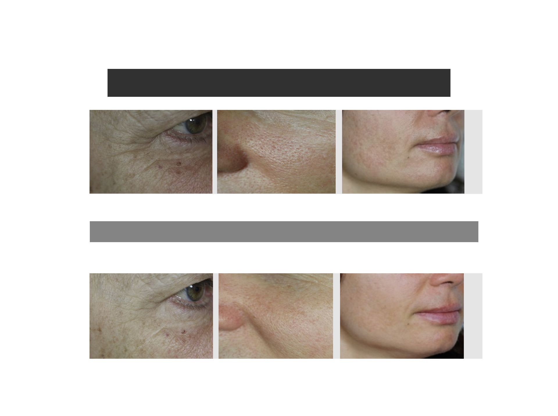 Before and after comparison of Fillmed clinical results