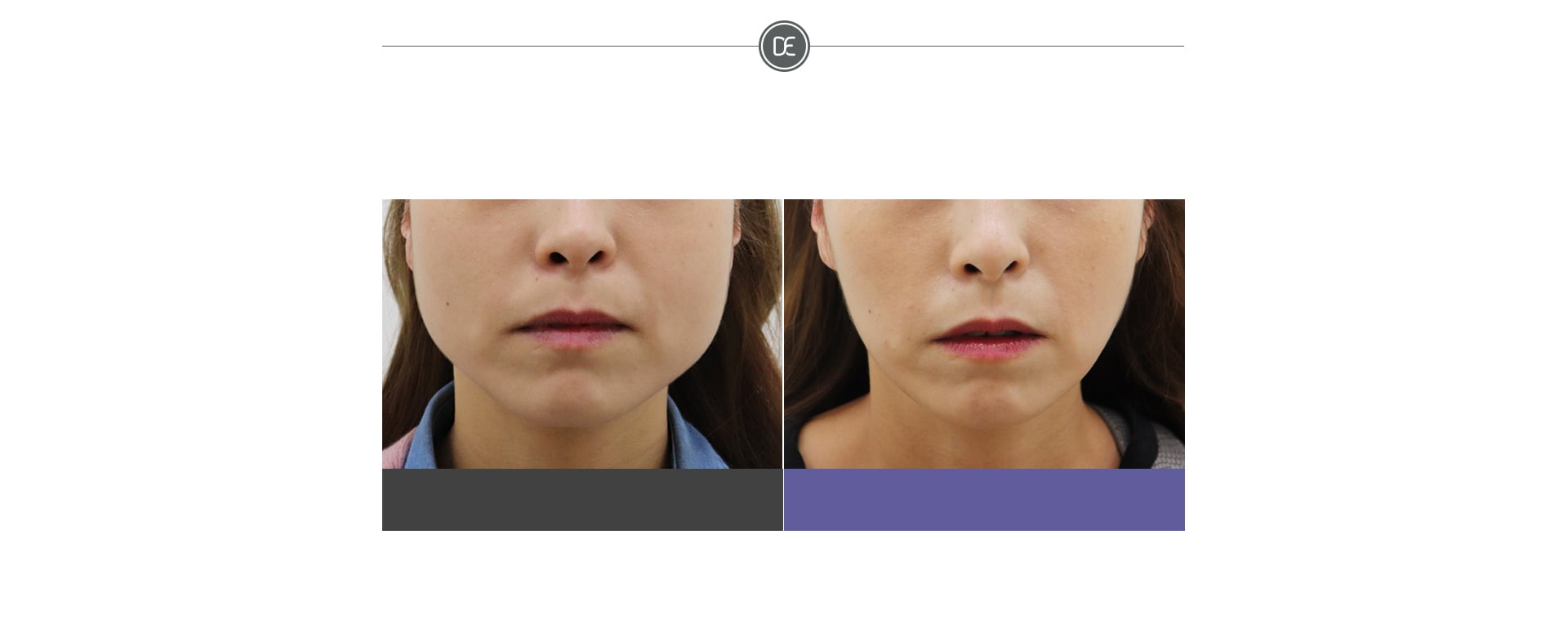 Evers Botox before and after 1