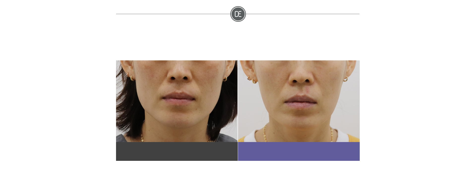 Evers Botox before and after 2