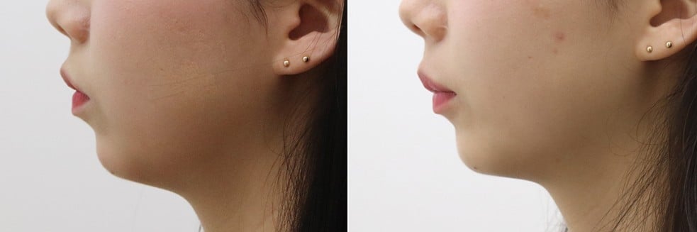 Evers Before & After Photos