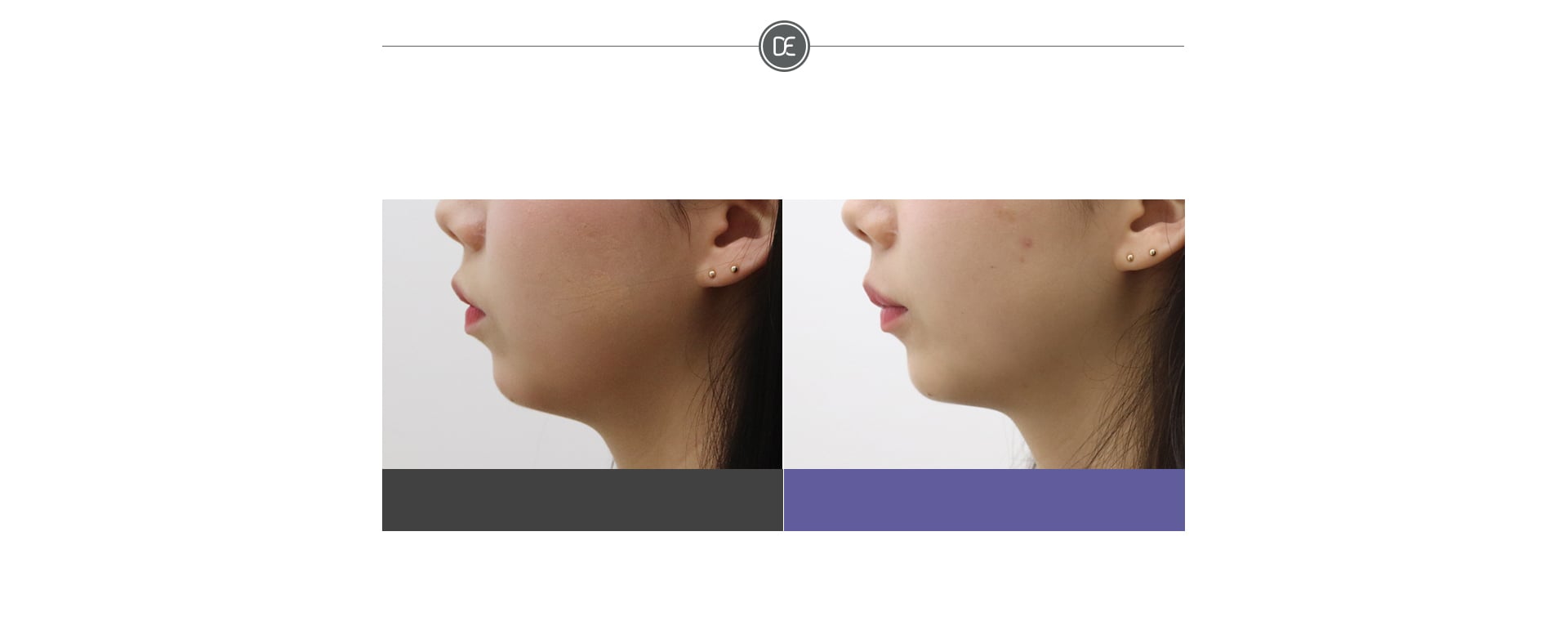 Evers Contouring Injection Before & After 1